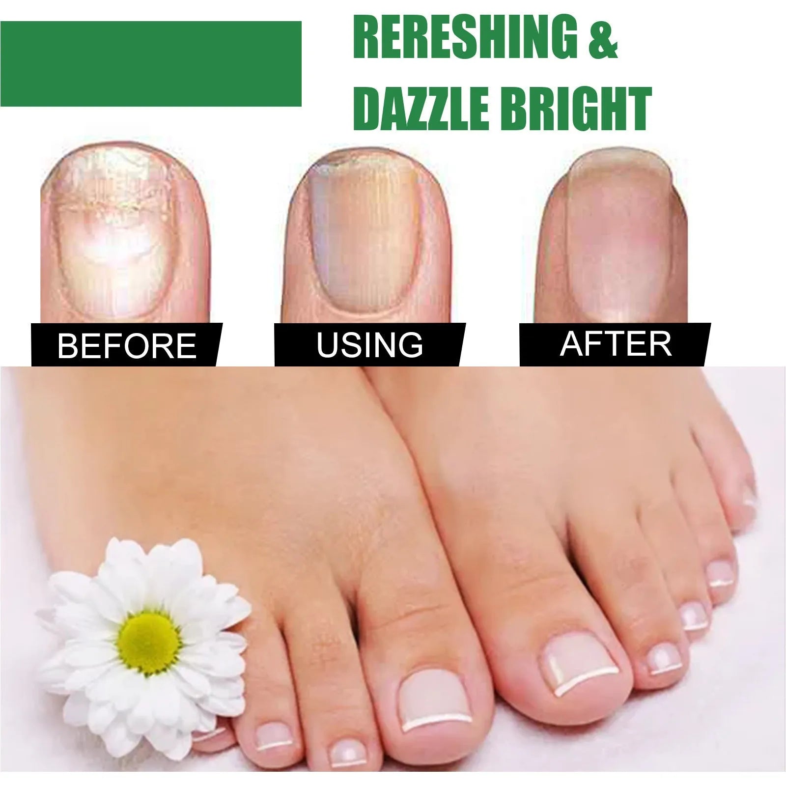 30ml bottle of tea tree oil foot and nail care solution for hand and foot maintenance.