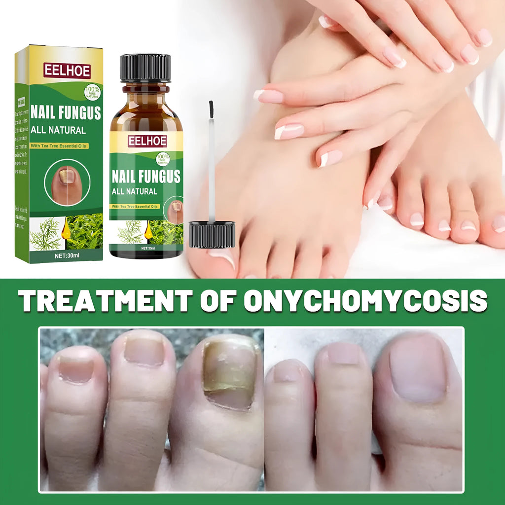 30ml bottle of tea tree oil foot and nail care solution for hand and foot maintenance.