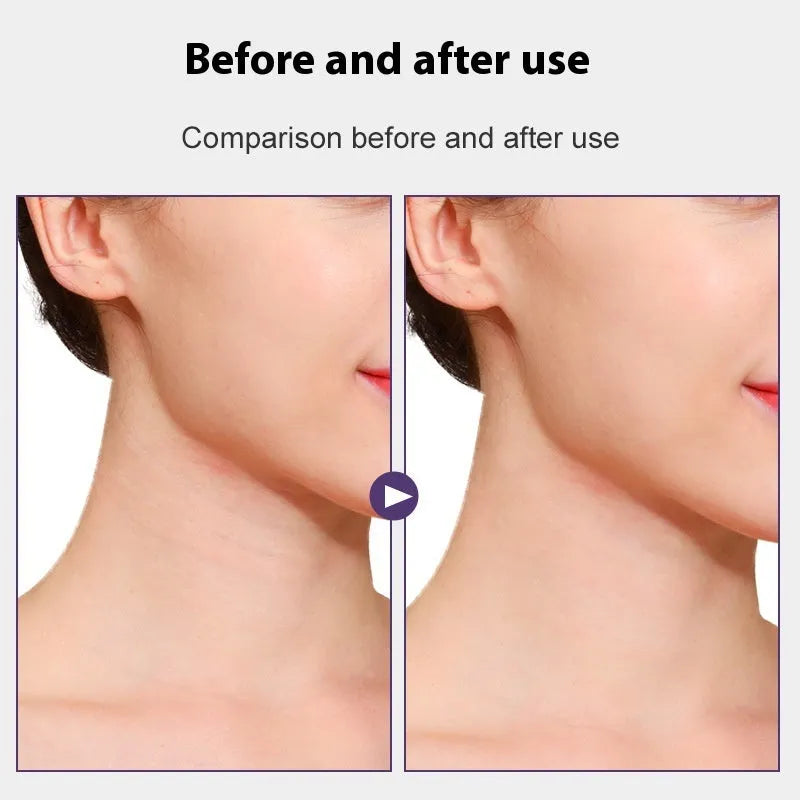 Skin-coloured neck pattern lifting strips adhesive tape set with 20 patches in 4 packs
