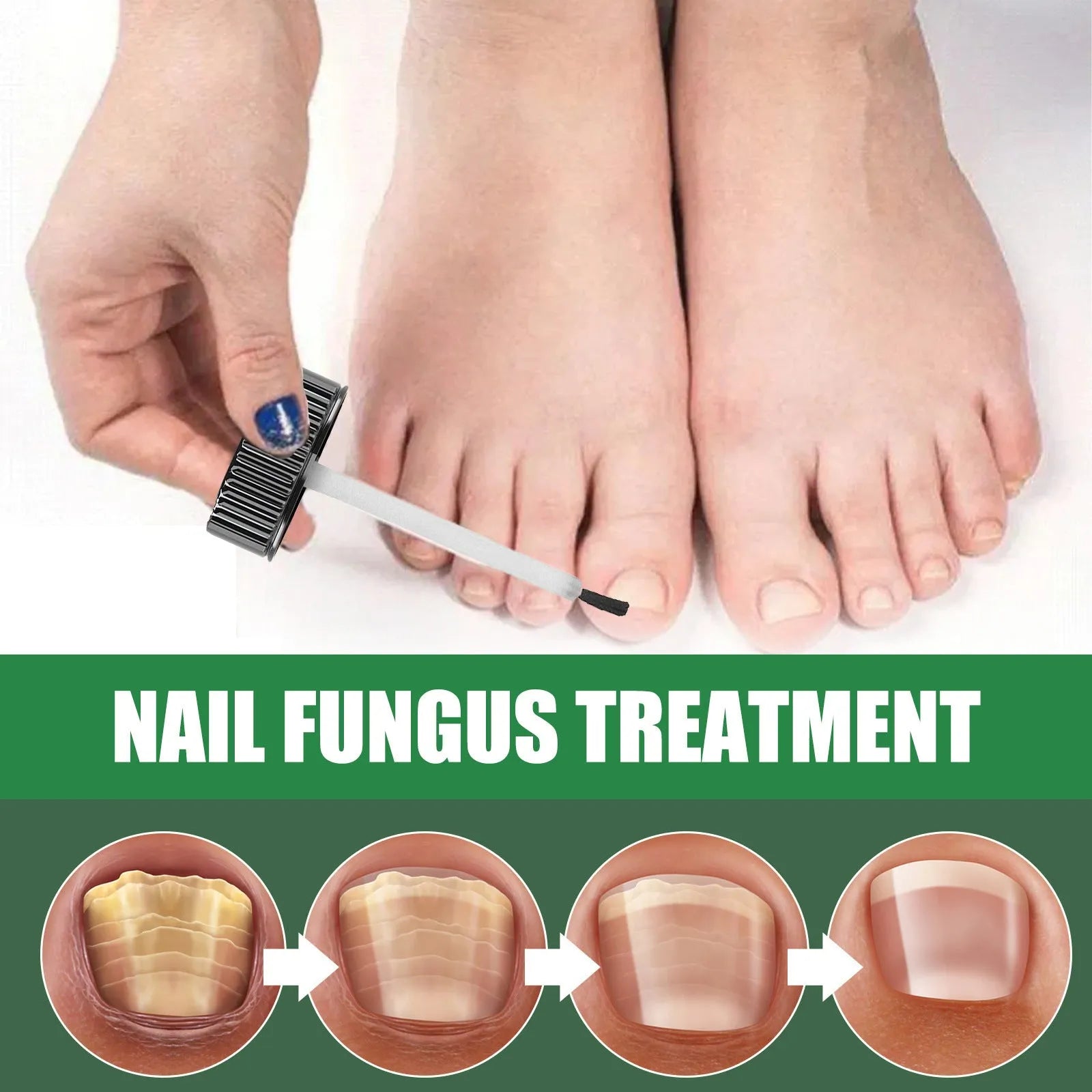 30ml bottle of tea tree oil foot and nail care solution for hand and foot maintenance.